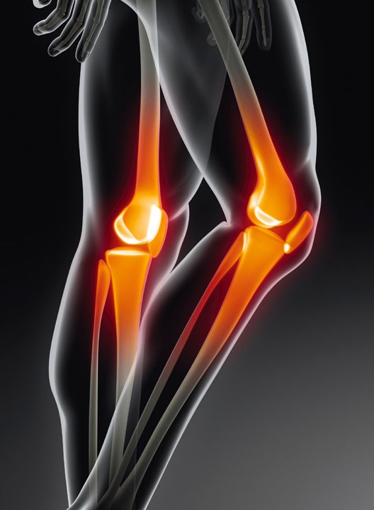 Knee Replacement